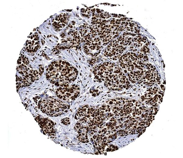 IHC of Ovarian Cancer cells labeled with DSHB antibody CPTC-APEX1-2 against APEX Nuclease. Image credit: NCI-Clinical Proteomic Techenologies for Cancer. 